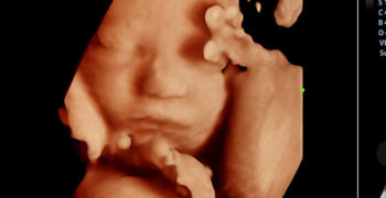 3D/4D ultrazvočni pregled