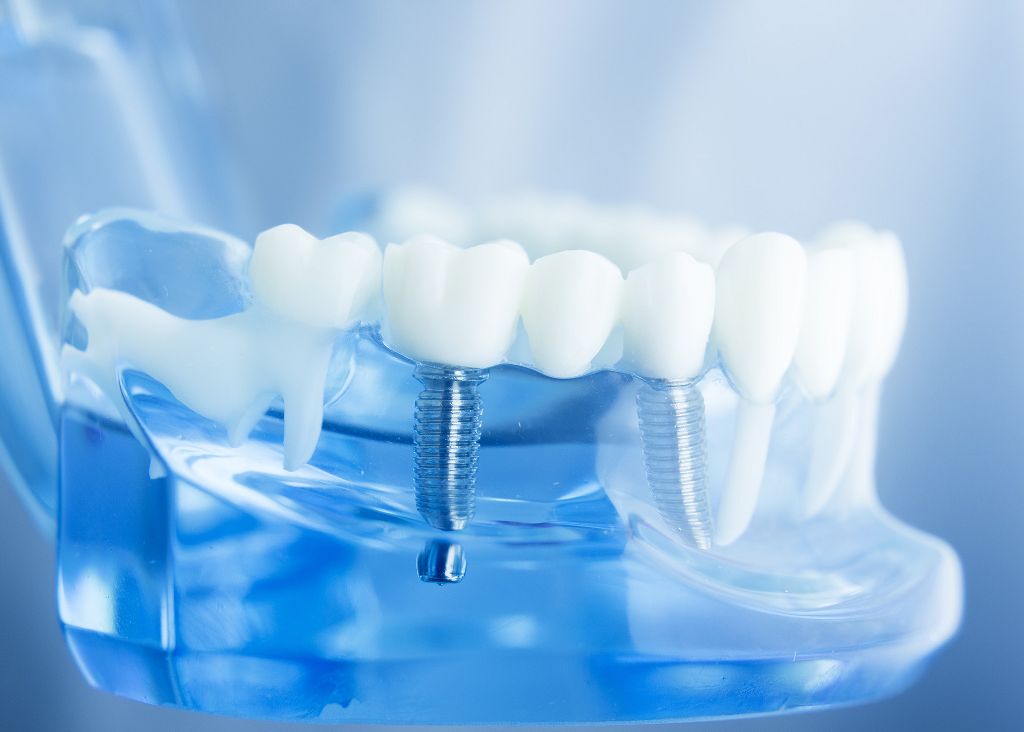 Zobni implantati